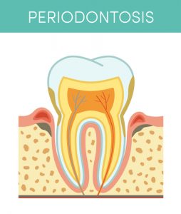 Tooth diseases: periodontosis, vector cartoon illustration