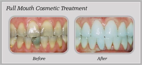 mouth cosmetic treatment before and after