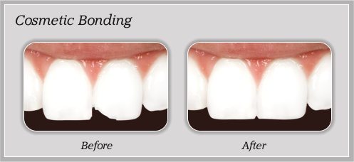 cosmetic bonding before and after