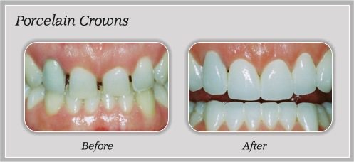 porcelain crowns before and after