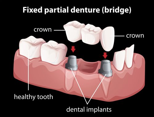 Illustration of a fixed partial denture