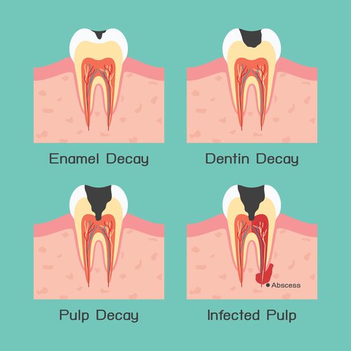 Diagram that illustrates enamel decay, dentin decay, pulp decay, and infected pulp