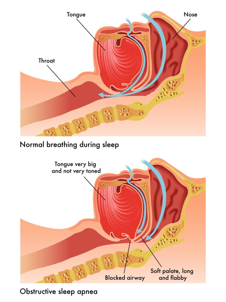 Obstructive Sleep Apnea Duff Family Dental Of Springfield MO